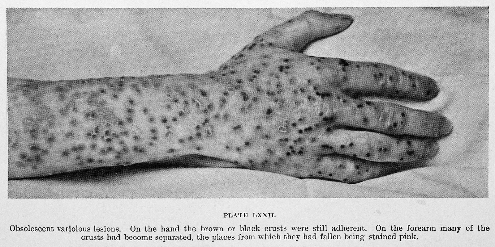 Arm smallpox